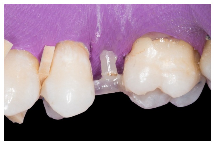Composite dental bridge